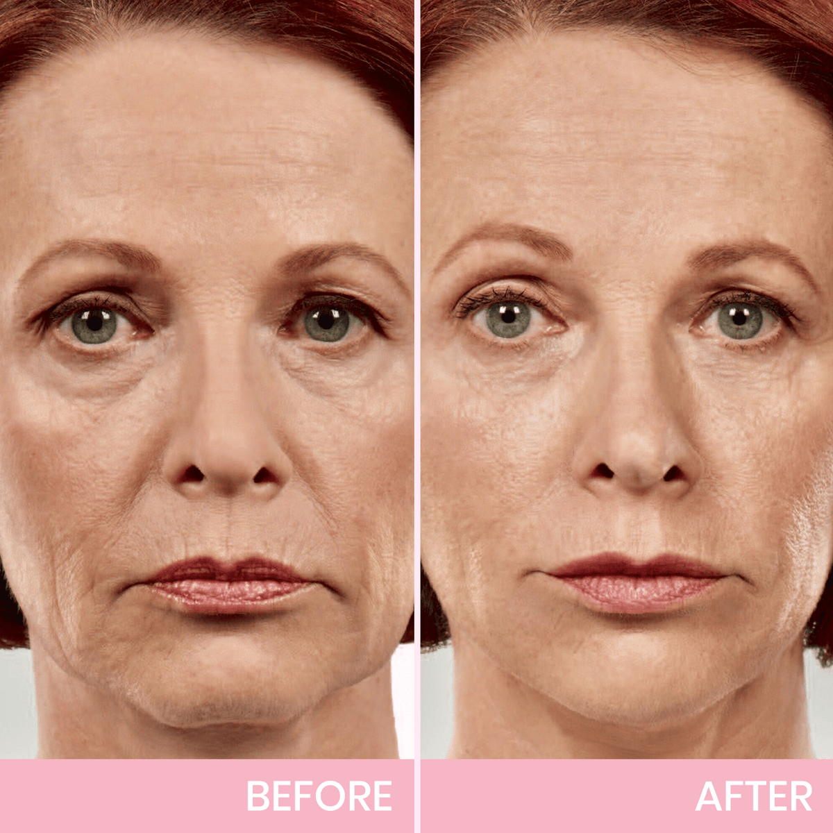BBOJI™ Invisible Face Lift Tape Instantly Sculpt Your Jawline & Hide Double Chin