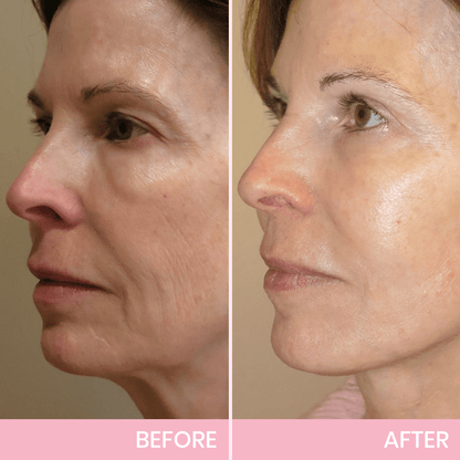 BBOJI™ Invisible Face Lift Tape  Instantly Sculpt Your Jawline & Hide Double Chin