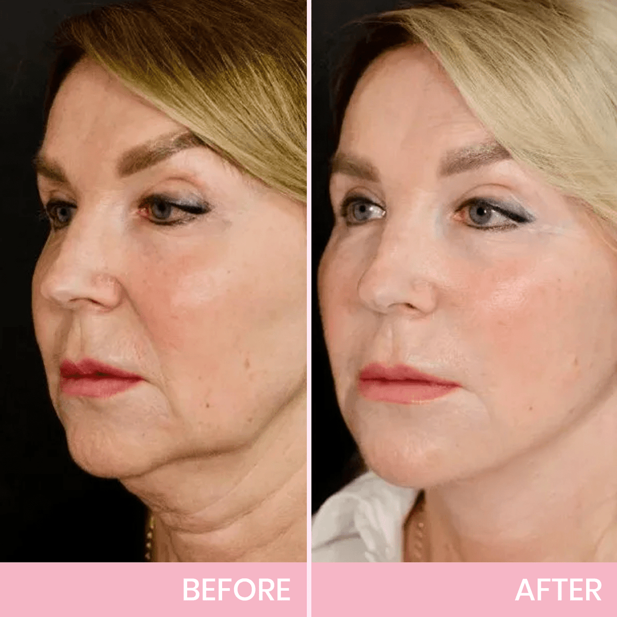 BBOJI™ Invisible Face Lift Tape  Instantly Sculpt Your Jawline & Hide Double Chin
